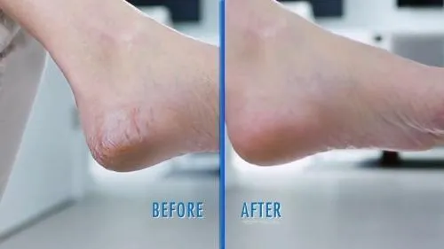 Electric Callus Remover - Built-In Vacuum Rechargeable Motorized Feet Foot Pedicure Tool Exfoliation Dead Skin